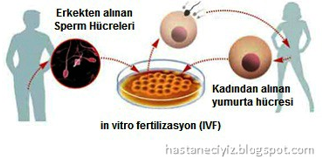 İn vitro fertilizasyon (IVF) da izlenen yollar